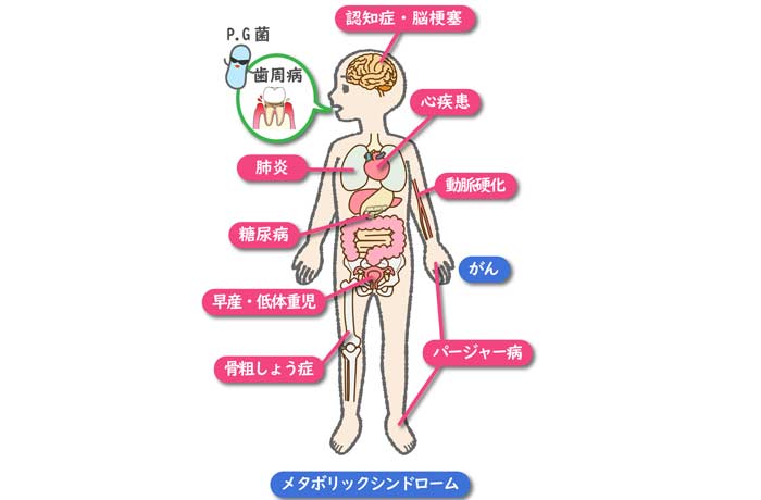 歯周病は全身疾患に関連します